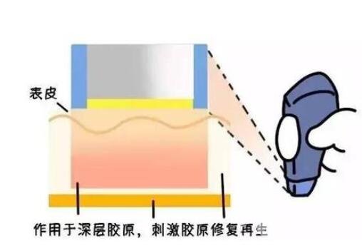 熱瑪吉手術(shù)果