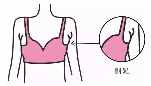 【科普】副乳切除手術(shù)幾天恢復(fù)？手術(shù)注意事項(xiàng)~
