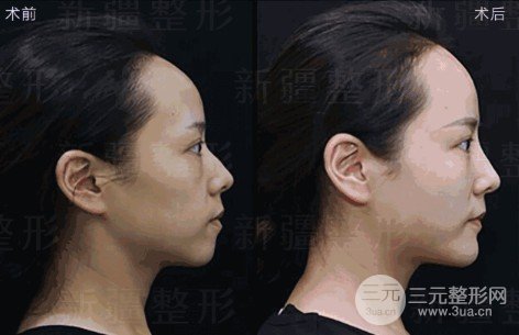 墊下巴前后對(duì)比圖