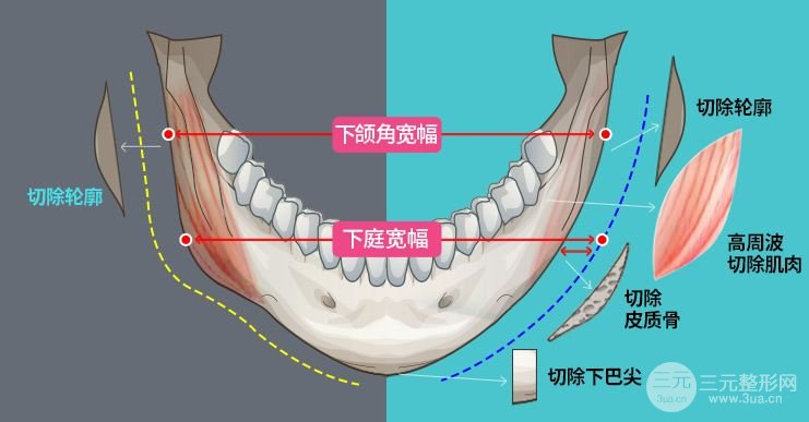做完下頜角后臉會(huì)下垂嗎?