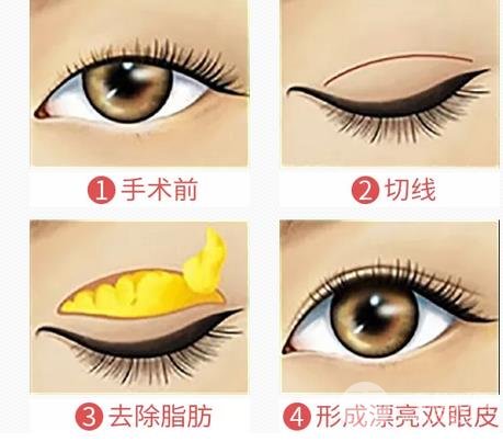 割雙眼皮幾種常見(jiàn)問(wèn)題