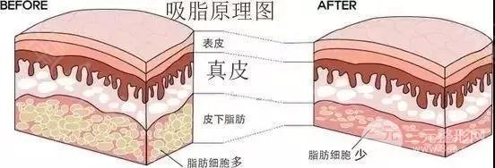 吸脂瘦大腿腫脹期是多久?