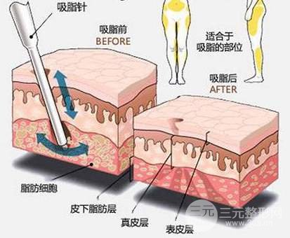 大腿吸脂原理