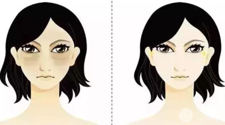 祛眼袋手術(shù)會反彈嗎