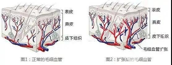 毛細(xì)血管擴張