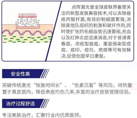 點陣激光