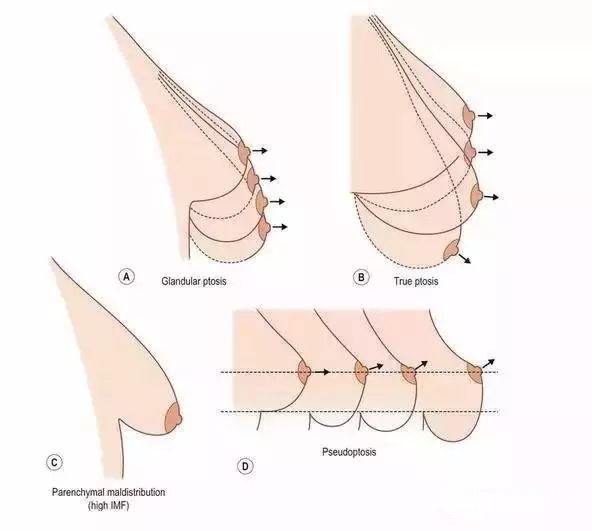 乳房下垂矯正優(yōu)勢(shì)：