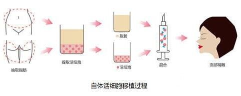 脂肪填充臉部能維持多久?