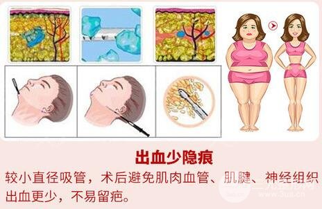 手術原理
