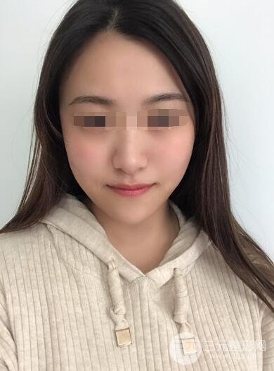 彩光祛痘案例分享