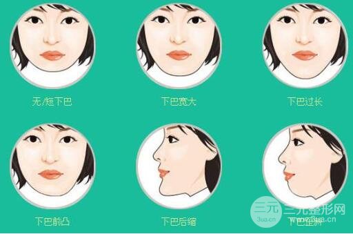什么人適合做假體墊下巴?