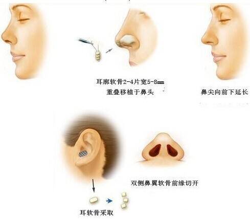 鼻頭縮小手術(shù)多久看見果?
