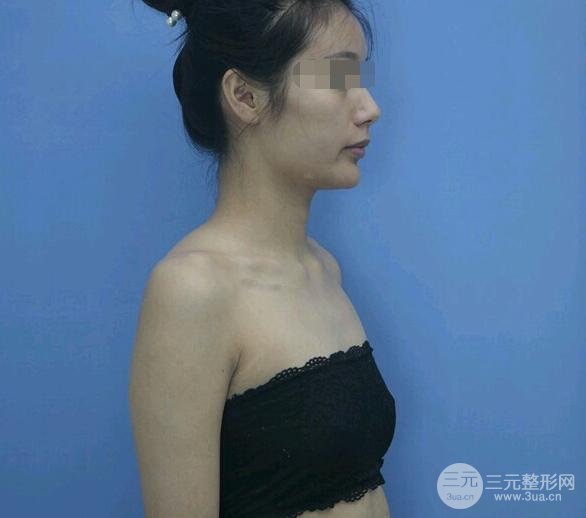 豐胸假體可以一輩子嗎?