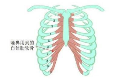 肋軟骨隆鼻手術(shù)恢復(fù)期多久?