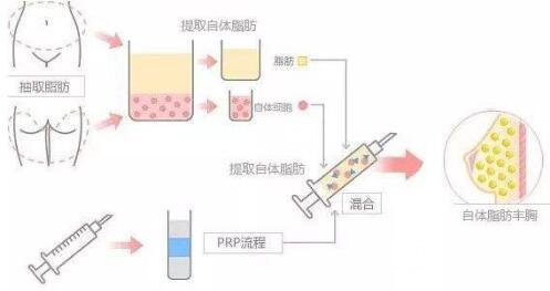 上海九院隆胸大概多少錢?幾有做呢?