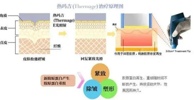 新一代熱瑪吉做一次多少錢