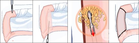 手術(shù)過(guò)程