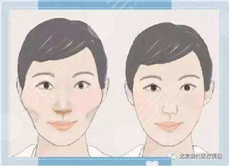 削骨怎樣變瓜子臉