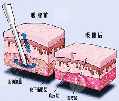 威塑抽脂和水動(dòng)力吸脂區(qū)別