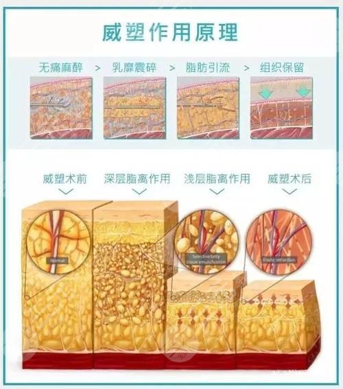 威塑抽脂
