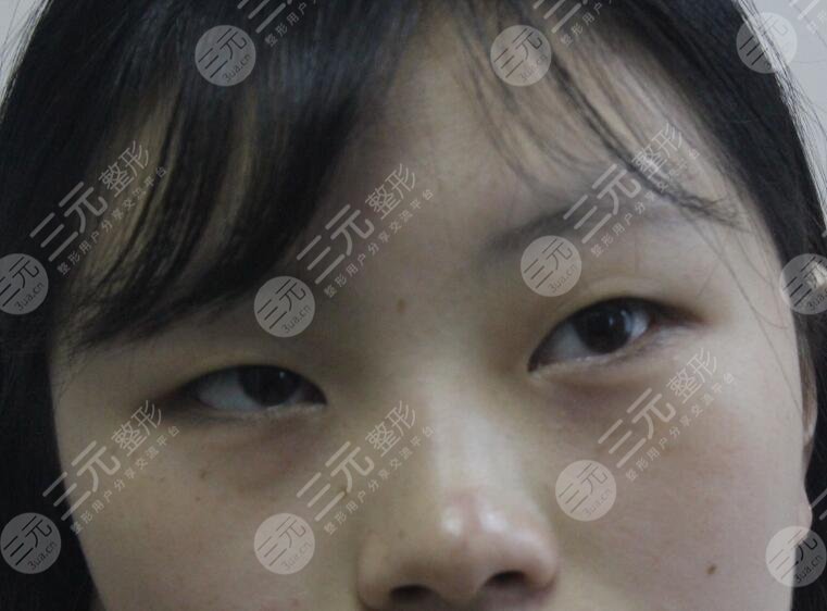 沈陽醫(yī)大一院黃威做雙眼皮案例前