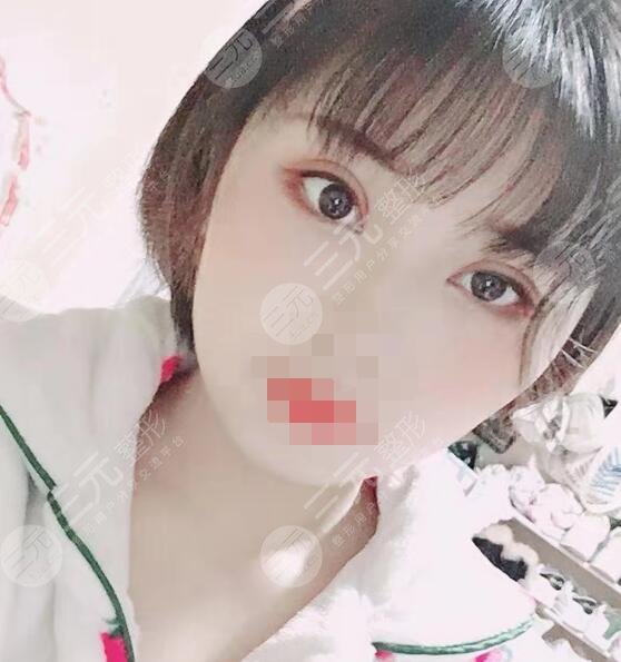 沈陽醫(yī)大一院黃威做雙眼皮案例2個(gè)月