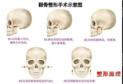瘦臉整形顴骨手術(shù)