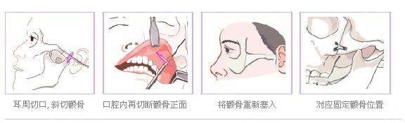 手術(shù)過(guò)程