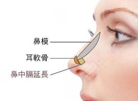 進(jìn)口膨體隆鼻一般要多少錢?