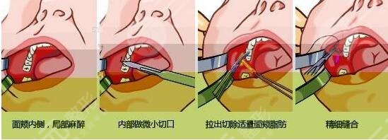 去頰脂墊手術(shù)簡介