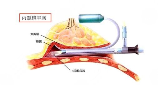 內(nèi)窺鏡雙平面隆胸和傳統(tǒng)隆胸區(qū)別是什么?