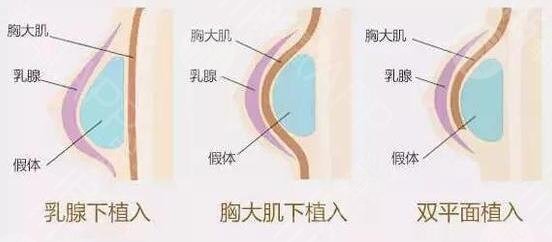 雙平面隆胸
