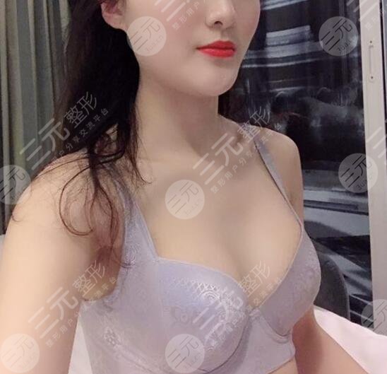 內(nèi)窺鏡隆胸案例后一個(gè)月