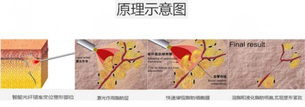 光纖溶脂瘦臉多久恢復