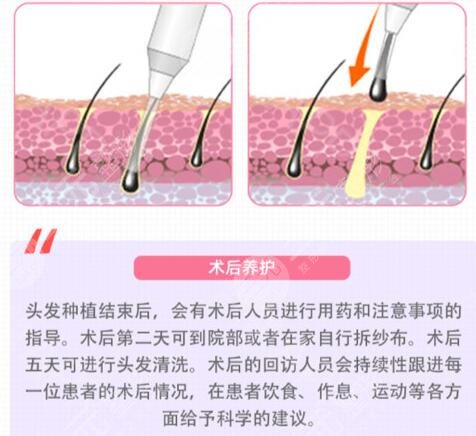 胡須種植手術(shù)風(fēng)險