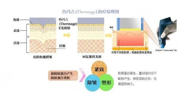 什么是熱瑪吉?