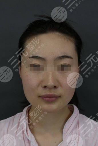 山大二院美容整形外科臉部下頜骨果圖