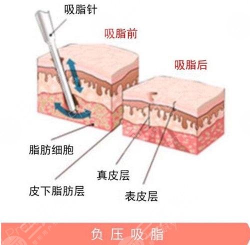 【科普】疼痛感較輕吸脂是怎么做的？吸脂手術(shù)有哪些方法呢？