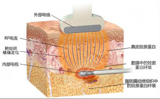 【科普】疼痛感較輕吸脂是怎么做的？吸脂手術(shù)有哪些方法呢？