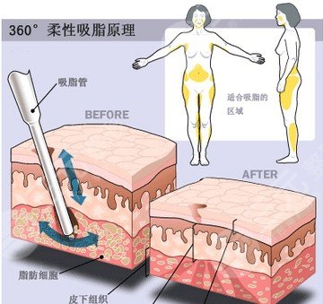 【科普】疼痛感較輕吸脂是怎么做的？吸脂手術(shù)有哪些方法呢？