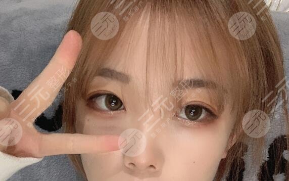 九院劉凱雙眼皮案例后半個月