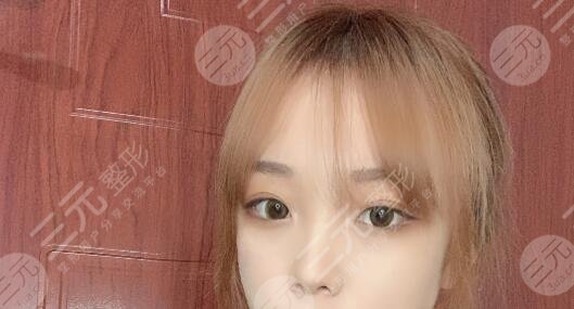 九院劉凱雙眼皮案例后1個月