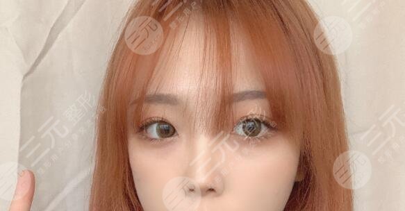 九院劉凱雙眼皮案例后6個月