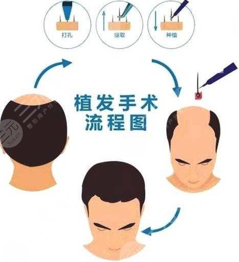 華山醫(yī)院植發(fā)多少錢