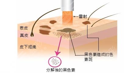 激光祛斑緩解前須知