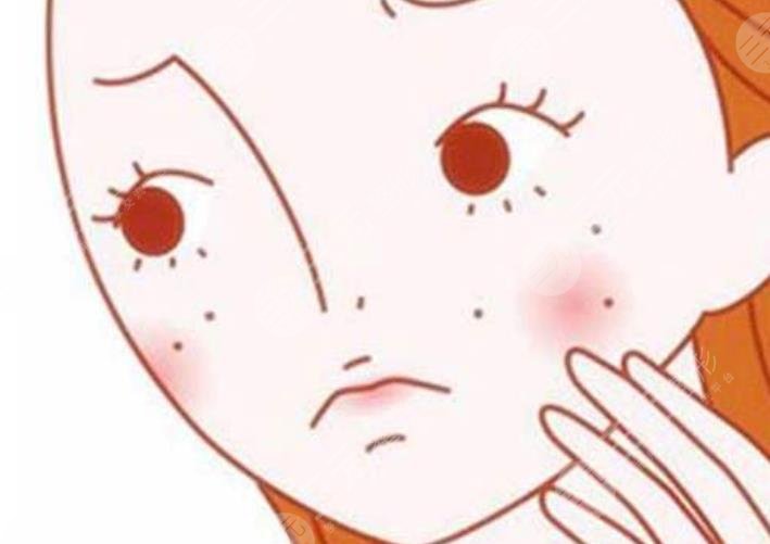 激光祛斑