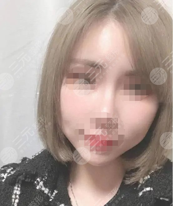 五v明星是埋線除皺?知識科普來嘍！附真人案例！