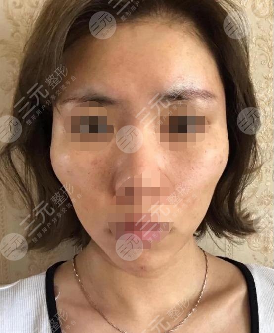 五v明星是埋線除皺?知識科普來嘍！附真人案例！