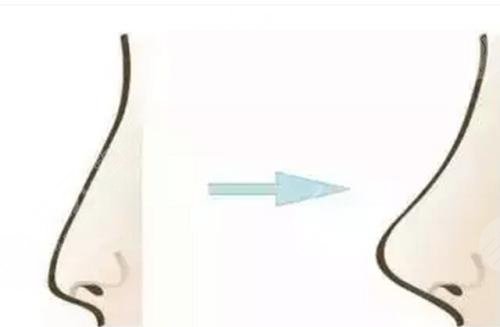 注射隆鼻的優(yōu)勢