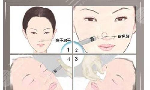 注射隆鼻后如何護理?